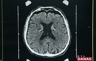 Liječnici u Zagrebu ugradili čovjeku stimulator mozga. "Može voziti bicikl, plivati"