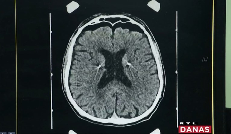 Liječnici u Zagrebu ugradili čovjeku stimulator mozga. "Može voziti bicikl, plivati"