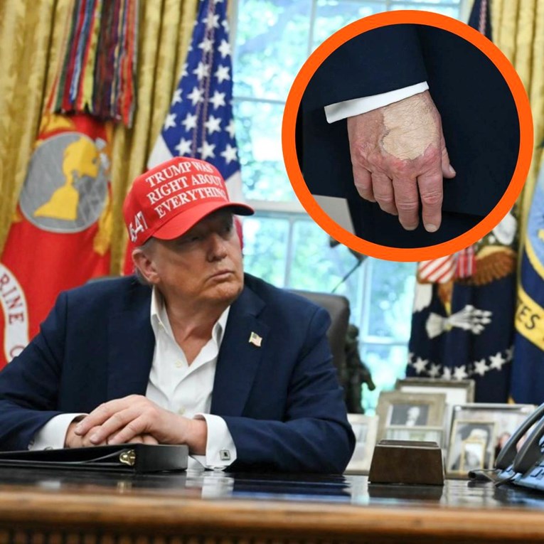 Novi tragovi na Trumpovim rukama potaknuli raspravu o njegovom zdravlju