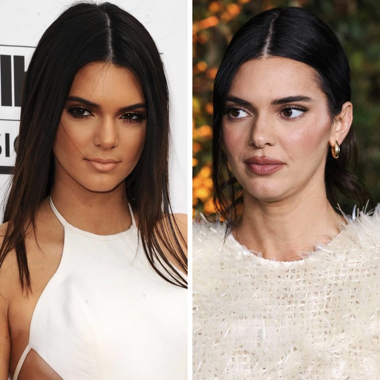 Kendall Jenner o glasinama da je operirala nos: "Promjene su od lijekova za akne"