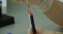Znanstvenici: Test krvi mogao bi pokazati tko među milijunima ljudi širi tuberkulozu