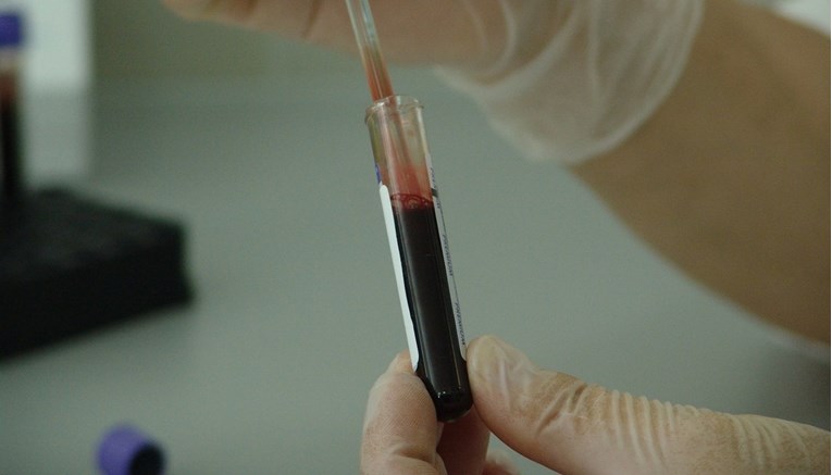 Znanstvenici: Test krvi mogao bi pokazati tko među milijunima ljudi širi tuberkulozu