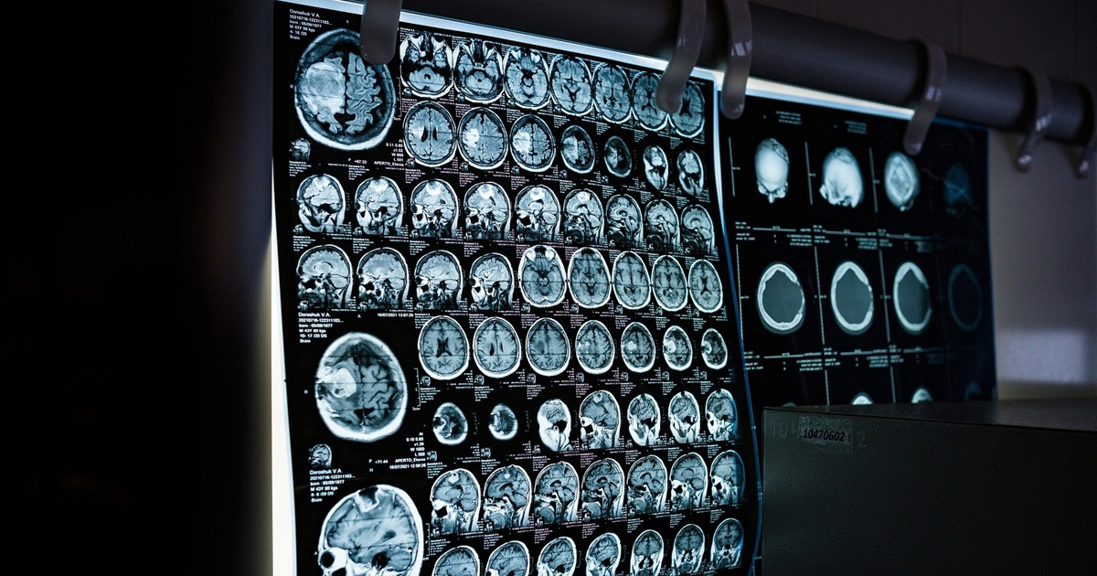 Obdukcija mozga otkrila zašto lijek protiv Alzheimera ne djeluje