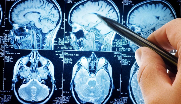 Ljudi koji imaju kopije specifičnih gena gotovo sigurno će oboljeti od Alzheimera