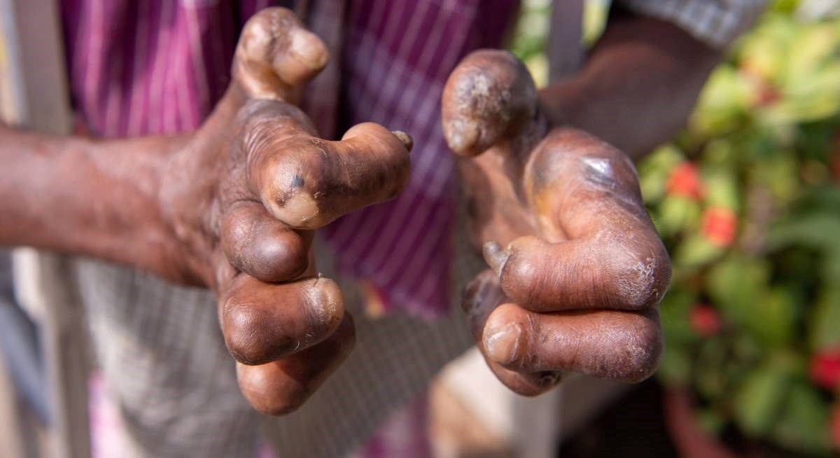 Otkriveno da bakterije gube imaju posebnu moć, mogu obnavljati organe životinja