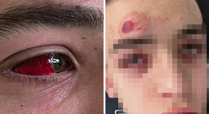 HDZ-ovac i MMA borac brutalno pretukao dečka (17) u Dubrovniku