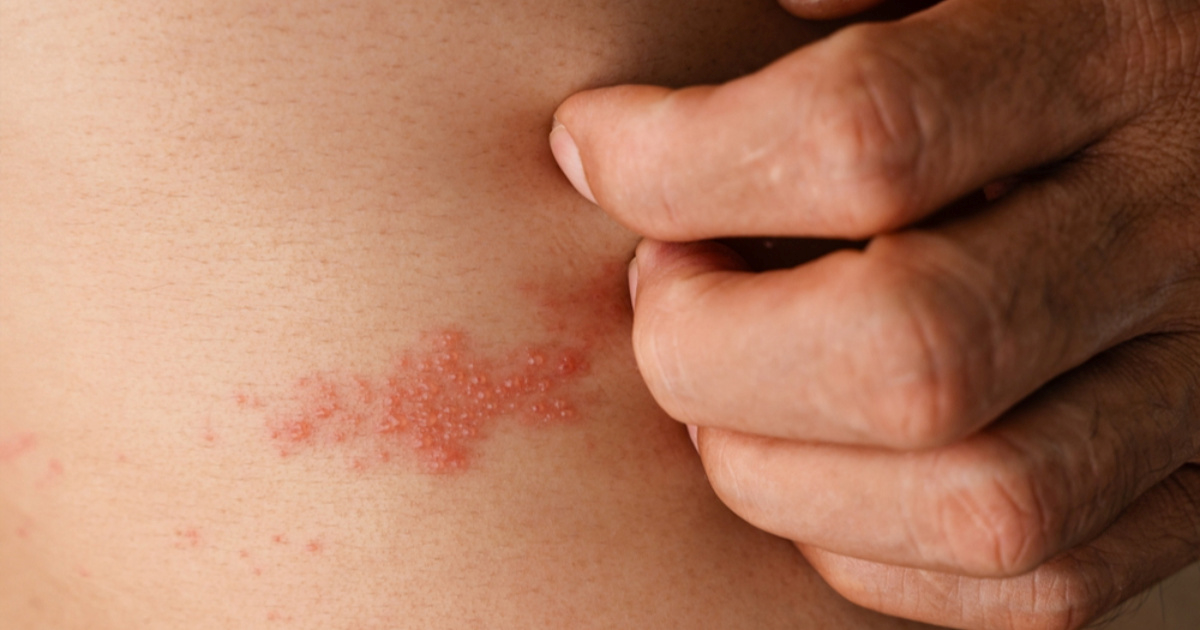 13 stanja koja izgledaju kao herpes, a nisu