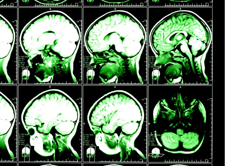 Znanstvenici skenirali mozgove mladih džihadista i dobili zabrinjavajuće rezultate