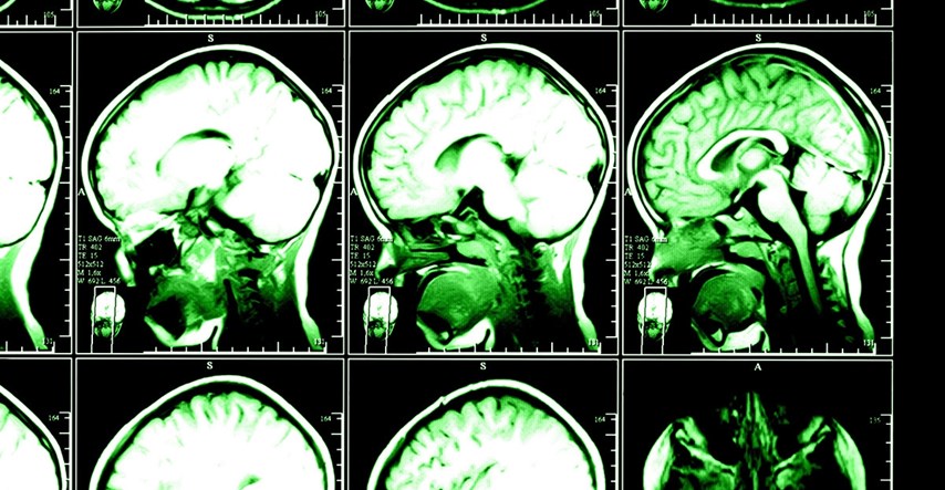 Znanstvenici skenirali mozgove mladih džihadista i dobili zabrinjavajuće rezultate