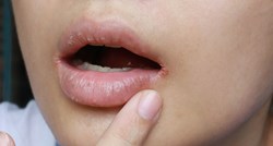 Znakove četiri bolesti možemo otkriti u ustima