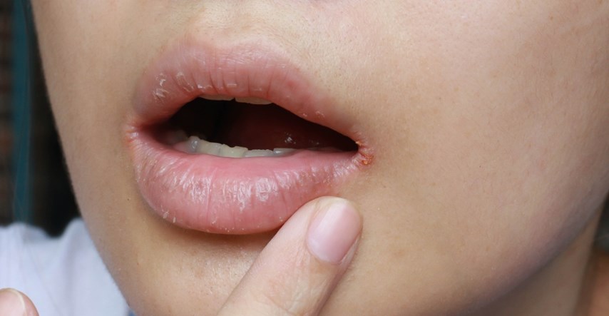 Znakove četiri bolesti možemo otkriti u ustima