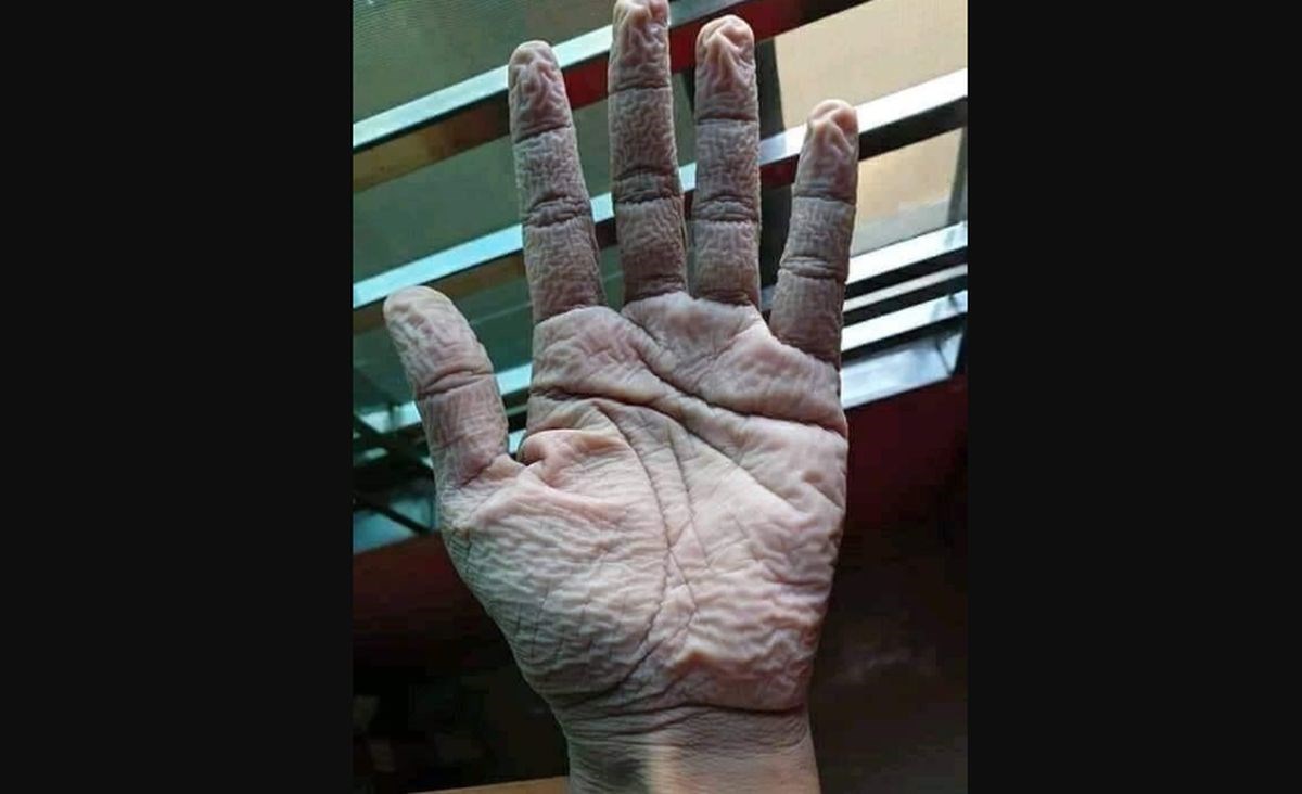Internetom se širi fotografija ruke liječnika koji je 10 sati nosio zaštitne rukavice