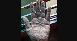 Internetom se širi fotografija ruke liječnika koji je 10 sati nosio zaštitne rukavice