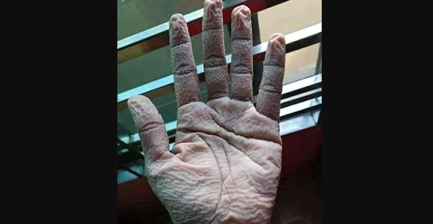 Internetom se širi fotografija ruke liječnika koji je 10 sati nosio zaštitne rukavice