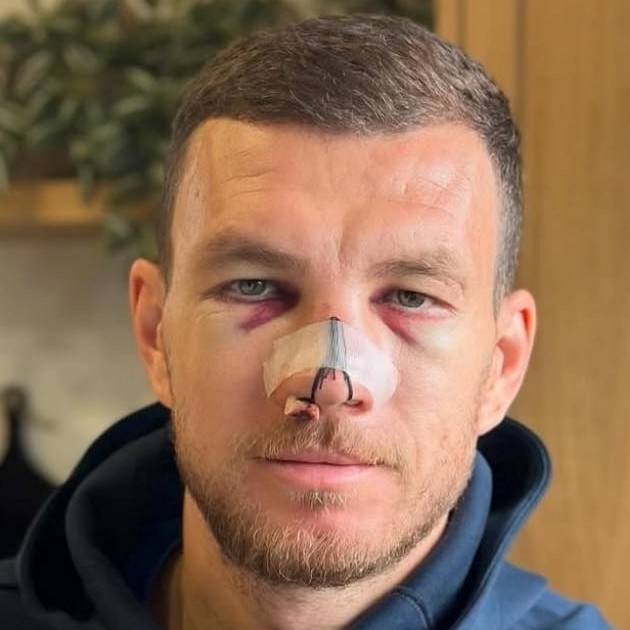 Pogledajte kako Džeko izgleda dva dana nakon što mu je kung-fu potezom slomljen nos