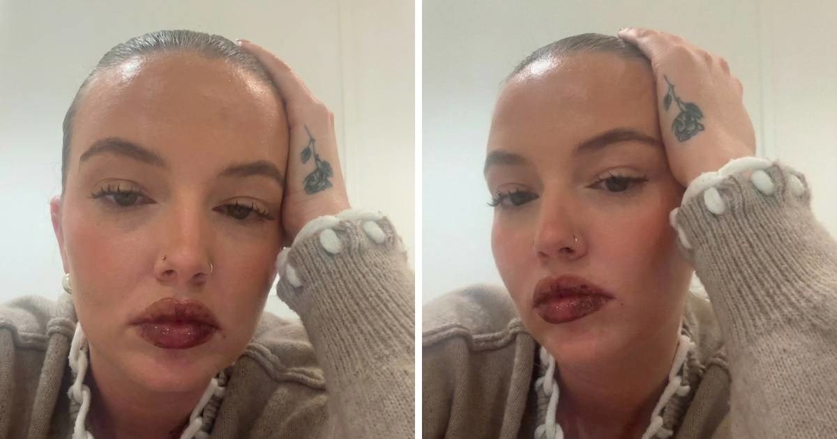 Platila 460 eura za popularan tretman usana pa pokazala što joj se dogodilo