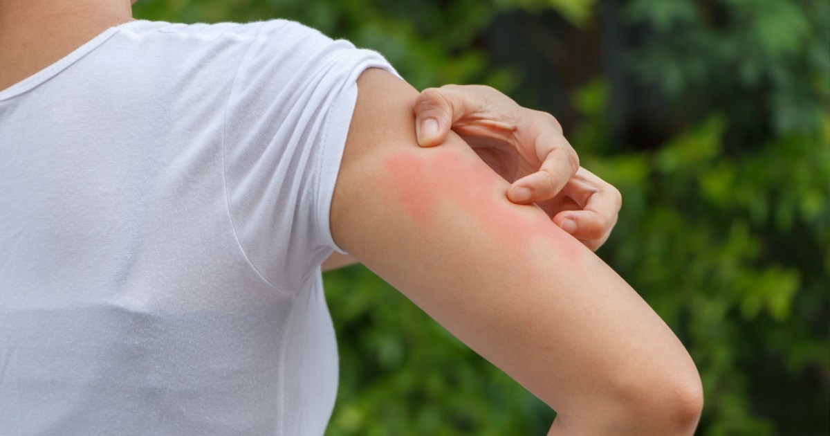 Istraživanje pokazalo: Stres iz djetinjstva povećava rizik od razvoja psorijaze