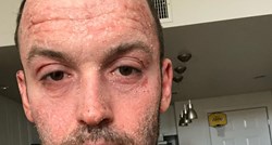 Muškarac tvrdi mu je prestanak korištenja steroidnih krema spasio kožu
