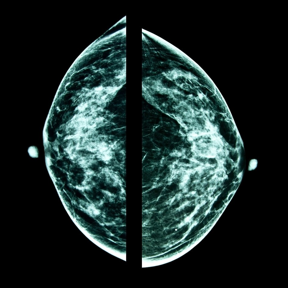 Barbara je imala tumor od 6 mm. Otkrila ga je umjetna inteligencija, ne doktori