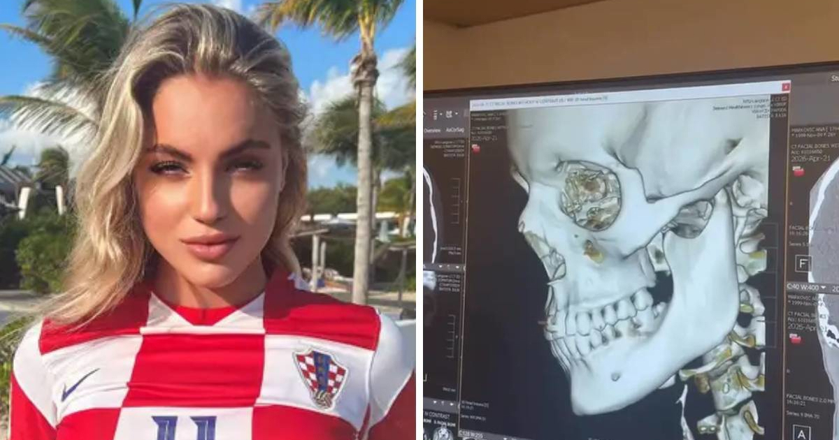 FOTO Hrvatska reprezentativka slomila nos. Liječnici su joj ga vraćali na mjesto