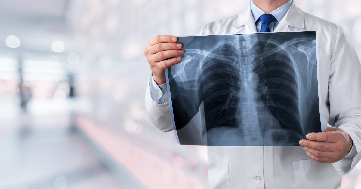 Sve više nepušača obolijeva od raka pluća. Onkologinja objasnila zašto se to događa