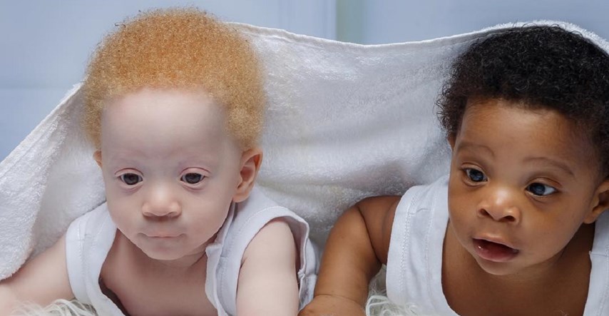 Preslatki blizanci postali zvijezde, rođeni su s različitom bojom kože