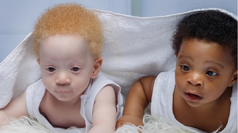 Preslatki blizanci postali zvijezde, rođeni su s različitom bojom kože