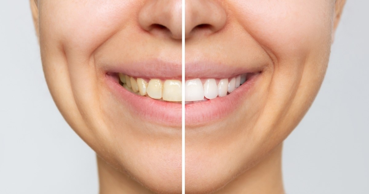 Stomatologinja kaže da ljudi tijekom dana čine tri pogreške zbog kojih zubi žute