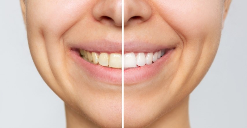 Stomatologinja kaže da ljudi tijekom dana čine tri pogreške zbog kojih zubi žute