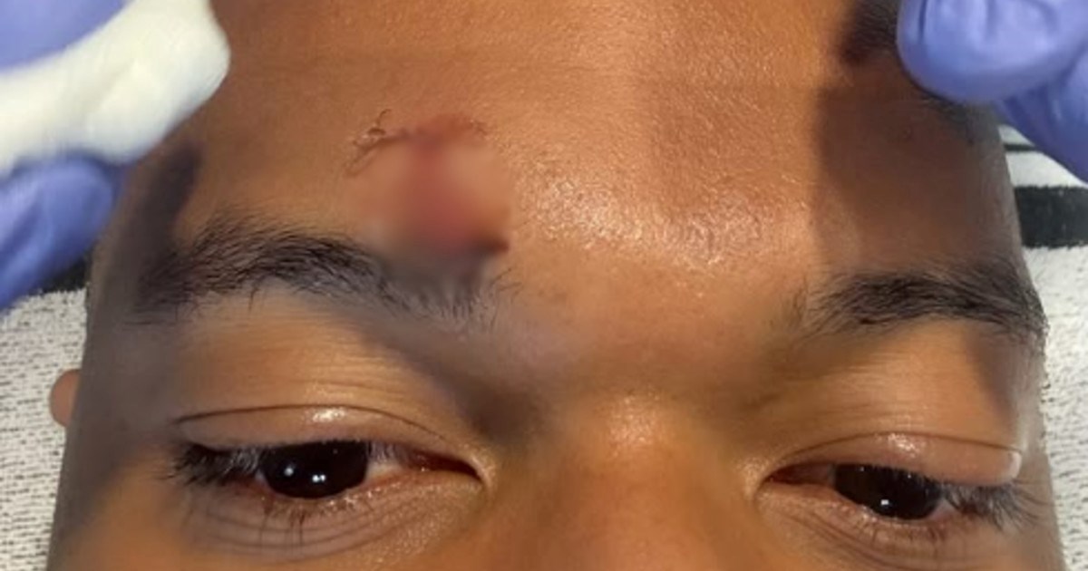 Mbappe objavio fotku. Pogledajte ozljedu za koju Real nije dobio penal