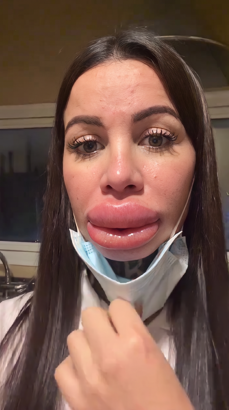Otišla na tretman filerima za usne, rasplakala se kad je ugledala rezultat