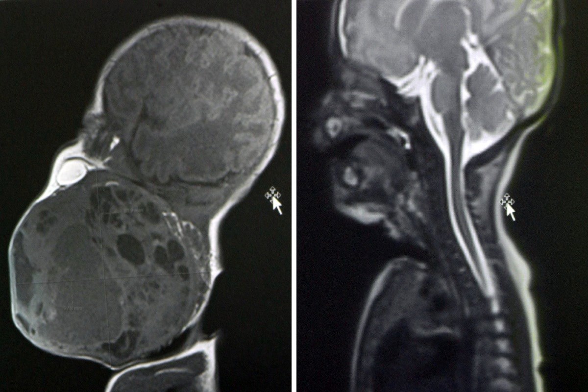 U Zagrebu tijekom poroda odstranili bebi ogroman tumor. "Bilo nas je 20 u sali"