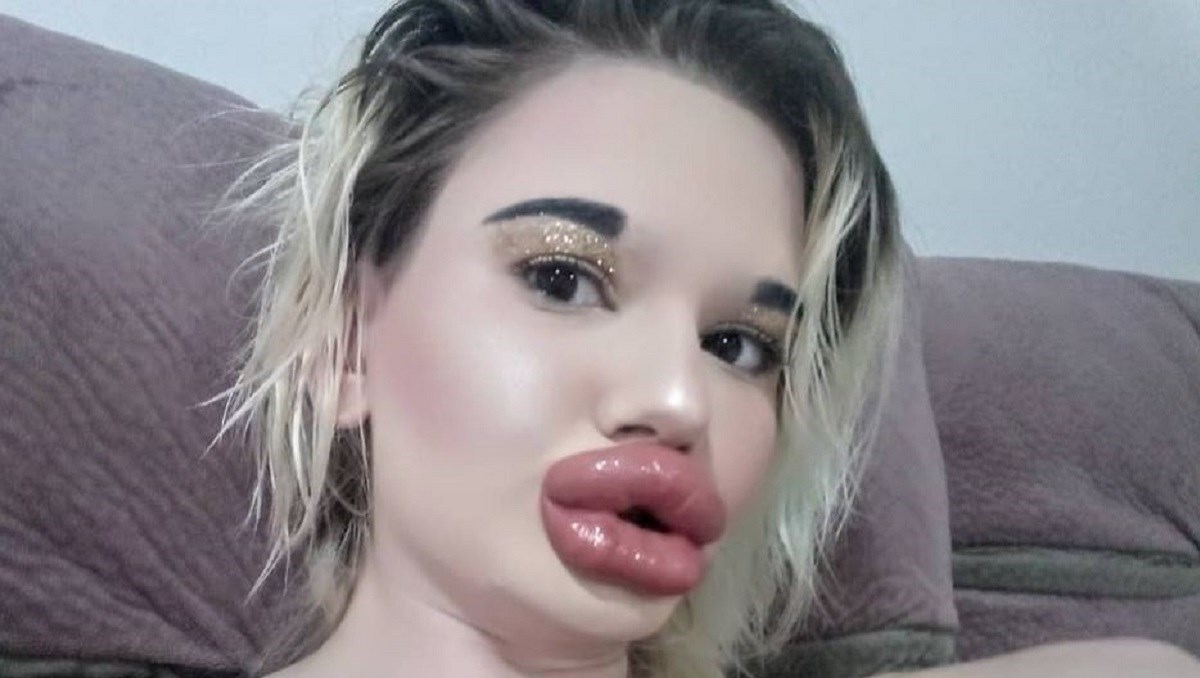 Studentica potrošila više od 23.000 kn na filere jer želi najveće usne na svijetu