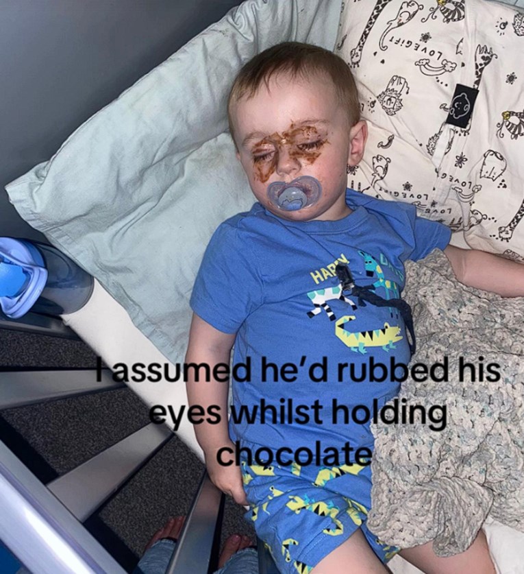 Mama primijetila da sin ima čudne mrlje oko očiju, a onda je shvatila što se dogodilo