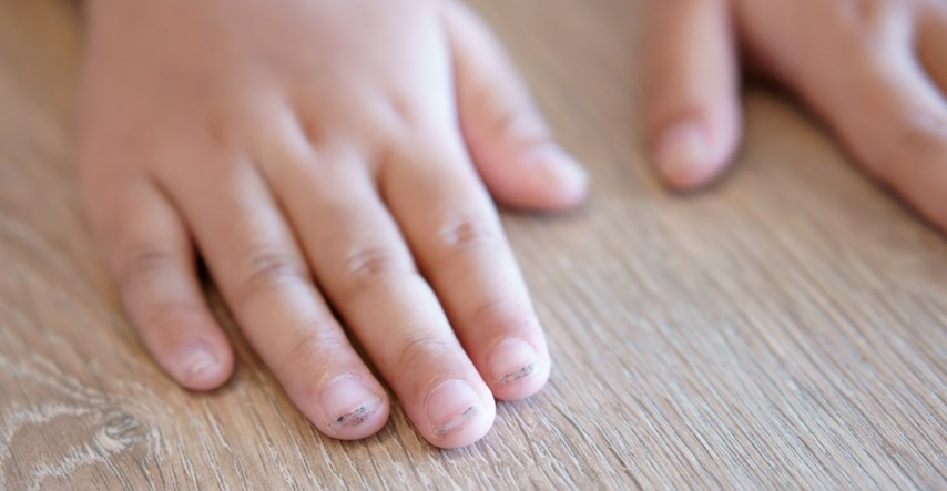 Što znače promjene u boji dječjih noktiju?