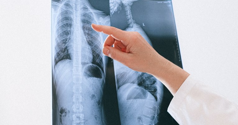 Ove manje poznate simptome raka pluća nikada ne bismo smjeli ignorirati, kažu doktori