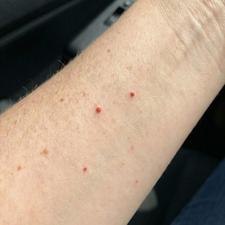 Što su one male crvene točkice na koži i trebaju li vas brinuti?
