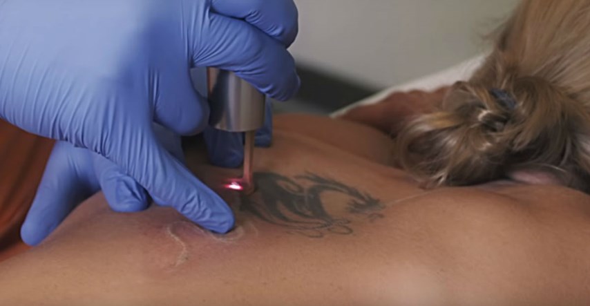 Kako nestaju tetovaže? Dermatolog otkriva detalje o proceduri uklanjanja