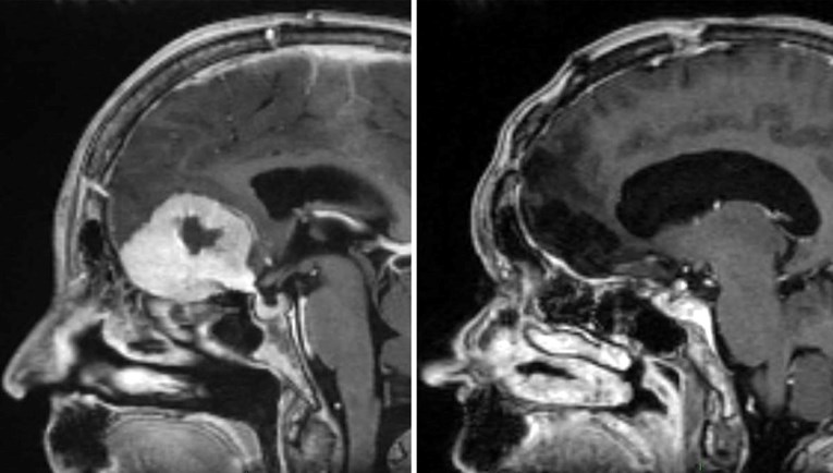 Kirurg uklanja veliki tumor mozga kroz obrve