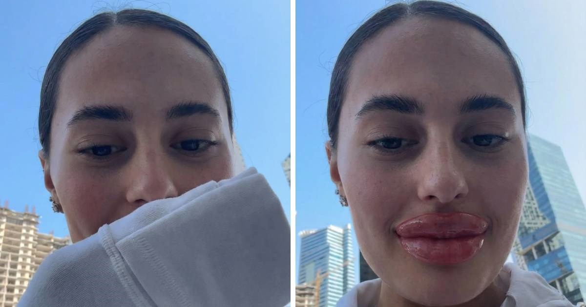 Prvi put isprobala "lip blush" pa pokazala rezultat, ljudi umiru od smijeha