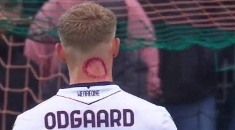 Veliki ožiljak na vratu asa Serie A privukao pažnju. Igrač objasnio kako je nastao