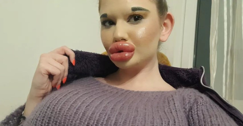Žena s najvećim usnama na svijetu nastavlja s tretmanima: Hoću biti kao Bratz lutka