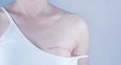 Osam žena otkrilo što morate znati prije dvostruke mastektomije