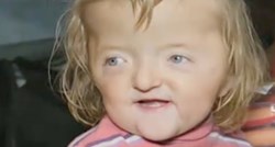 Dvogodišnjakinja nije upisana u vrtić jer njeno lice smatraju prestrašnim