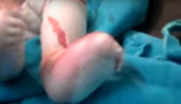 Roditelji iz Italije ostavili u bolnici bebu rođenu s rijetkom bolešću