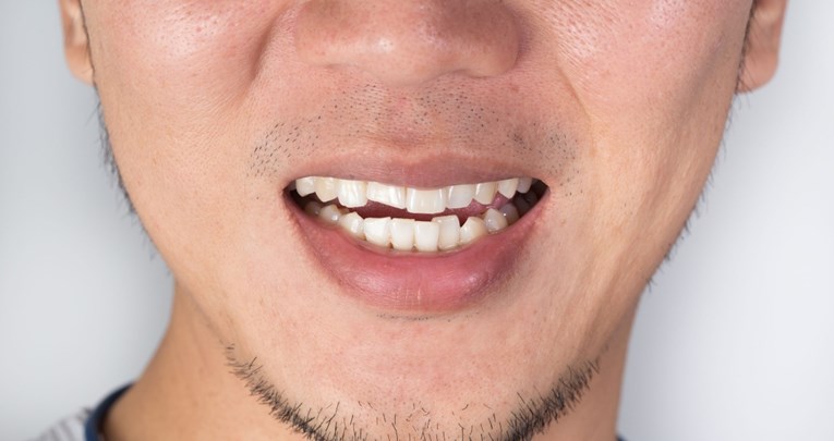 TikTok postao leglo opasnih izazova: Stomatolozi upozoravaju da ovime uništavate zube
