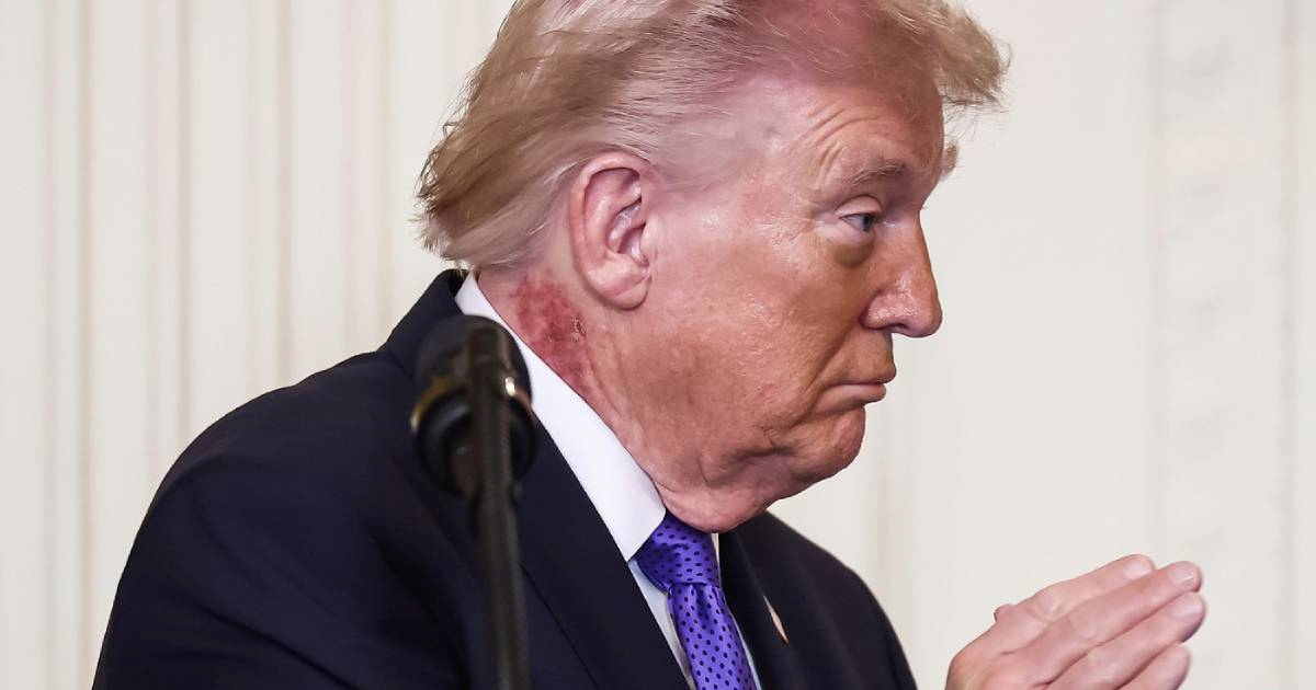 Mreže bruje o osipu na Trumpovu vratu, dermatolozi otkrili o čemu bi mogla biti riječ