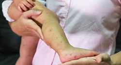 Epidemija u Koprivnici: Virusna bolest poharala vrtiće