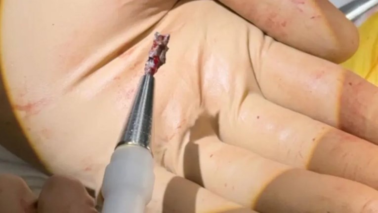 Magneti koji spašavaju živote u Ukrajini: "Izvadili su mi gelere iz srca"