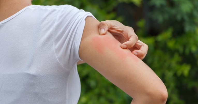 Istraživanje pokazalo: Stres iz djetinjstva povećava rizik od razvoja psorijaze